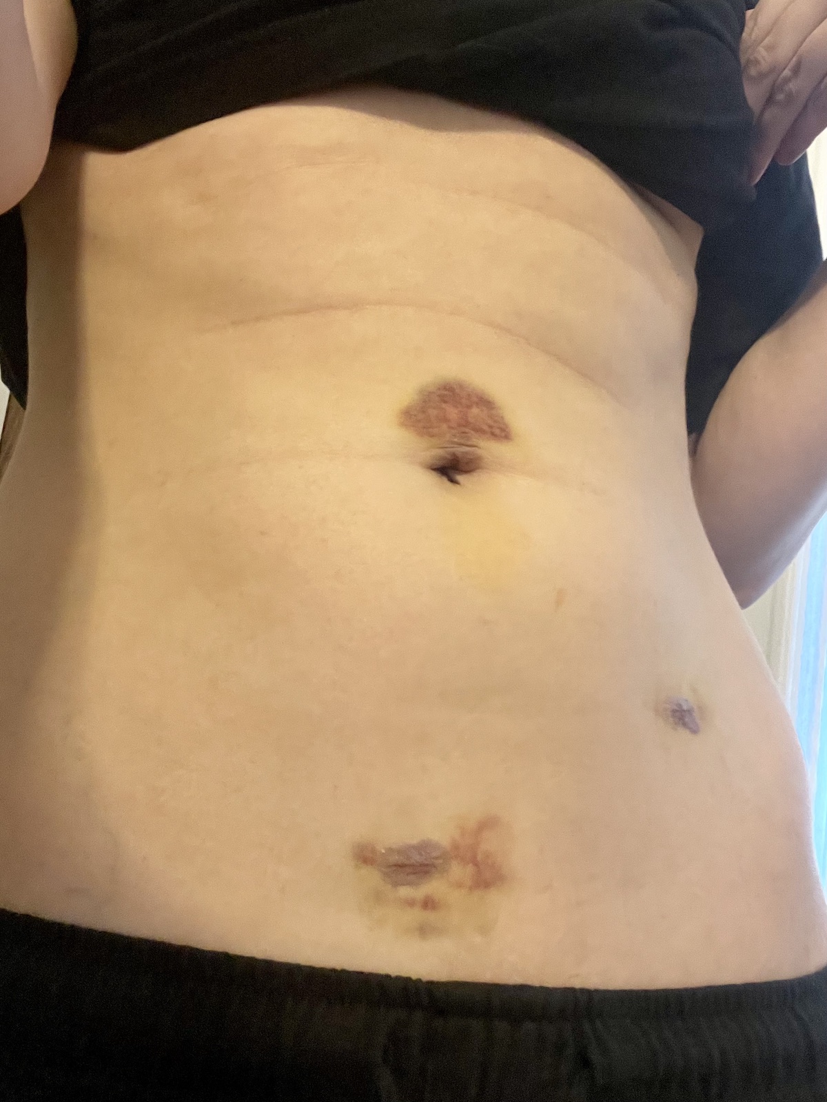 bare abdomen of an adult female showcasing three scars from surgery and the bruising